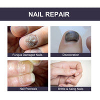 OUHOE Nail Repair Essence, Soft Nail Thickening Nails Smooth Ingrown Toenails Grey Nails Repair Essence