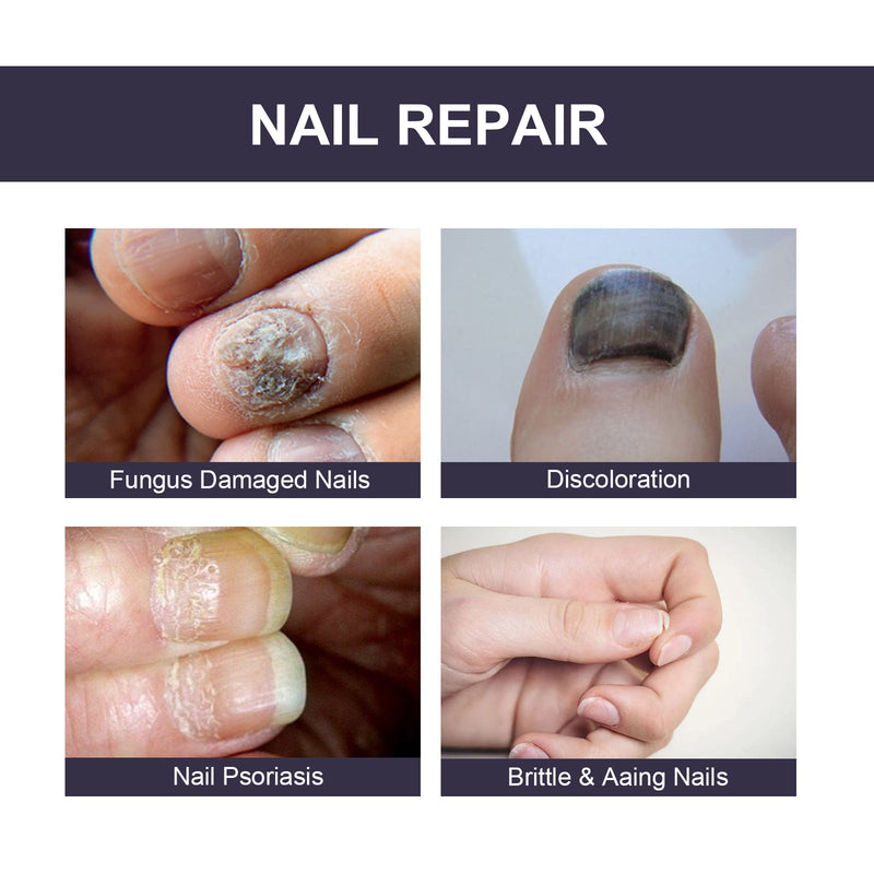 OUHOE Nail Repair Essence, Soft Nail Thickening Nails Smooth Ingrown Toenails Grey Nails Repair Essence