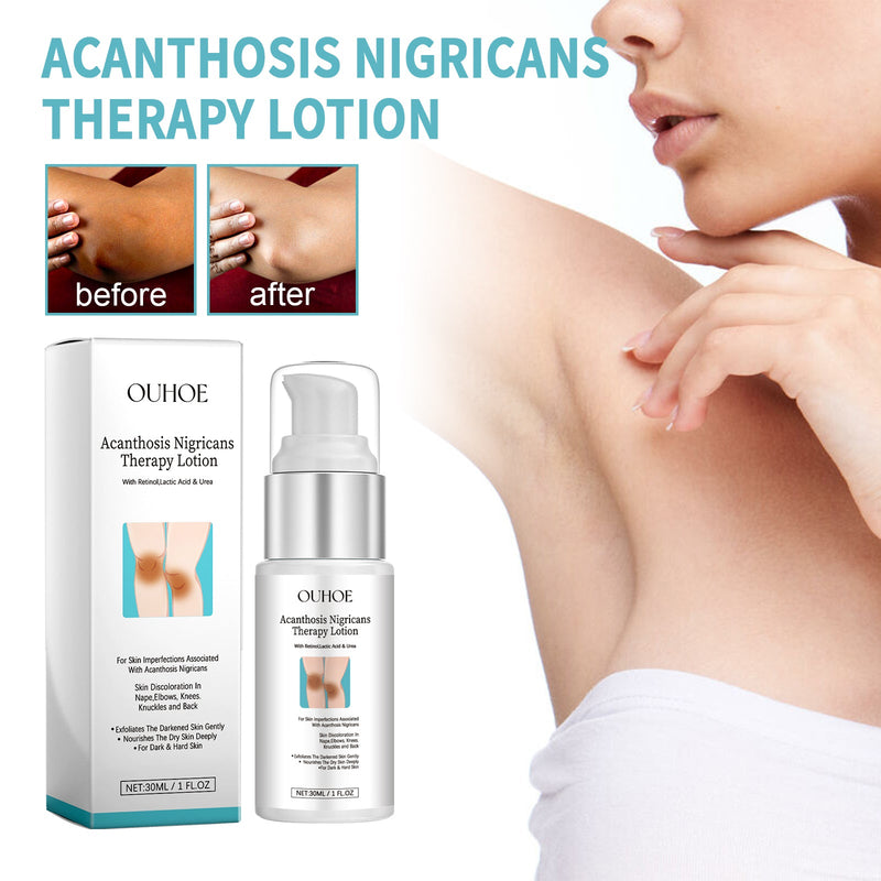 Acanthosis Nigricans Therapy Lotion, Armpit Joint Knee Fade Melanin Deep Nourishing Whitening Skin Tender Skin