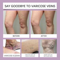 Varicose Veins Cream, Helps Relieve Leg Tightness And Improve Comfort