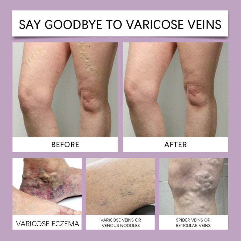 Varicose Veins Cream, Helps Relieve Leg Tightness And Improve Comfort