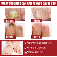 EELHOE Nail Repair Solution, Hands And Feet Nail Repair Moisturizing Clean And Remove Gray Nail Repair Solution