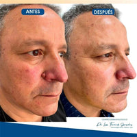 Flat and sharp warts, with a warm and moisturizing facial warts remover