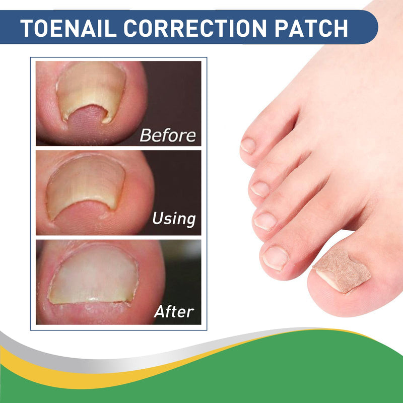 Toenail Furrow Correction, Toenail Insert Nail Repair Correction Pull-up Nail Nail Patch