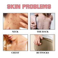 Exfoliating Body Soap, Removes Acne Exfoliating Lightens Acne Mark And Moisturizes Skin Cleansing Soap