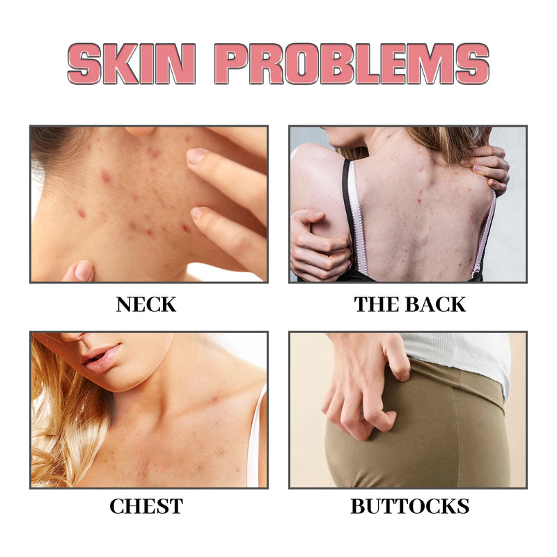 JAYSUING Exfoliating Body Soap - Removes Acne, Lightens Marks, Moisturizing