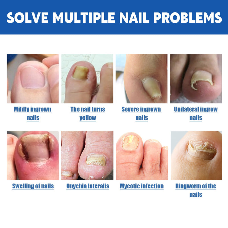 Nail Seam Care Patch, Repair Thickening Gray Nail Soft Nail Correction Nail Seam Patch