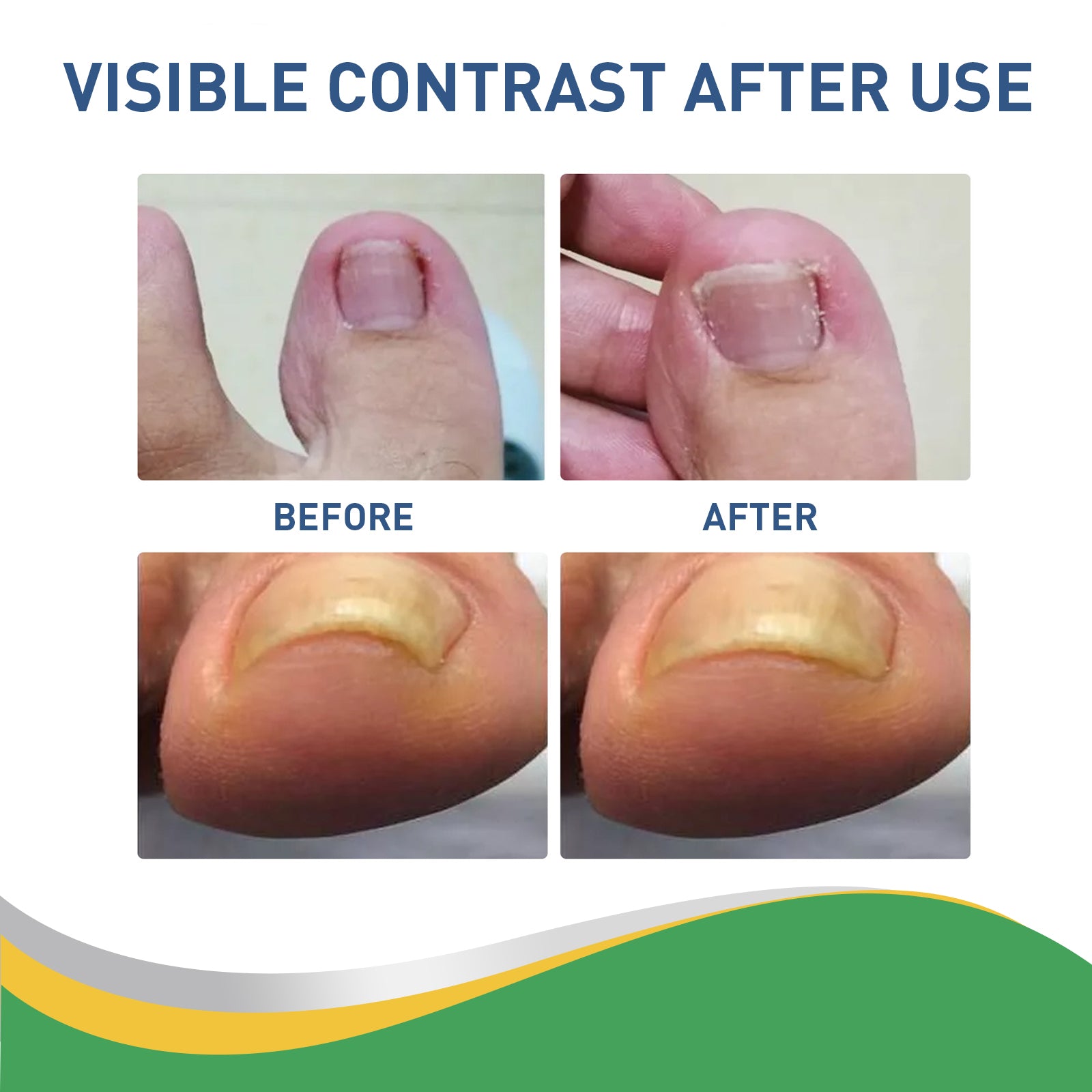 Toenail Furrow Correction, Toenail Insert Nail Repair Correction Pull-up Nail Nail Patch