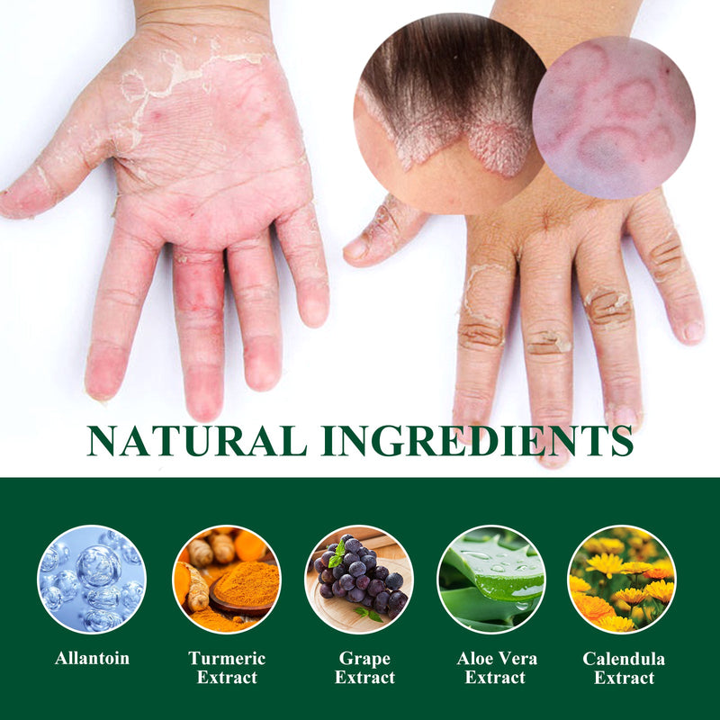 Skin Repair Cream, Relieve Skin Itching Blister Moss Care External Ointment