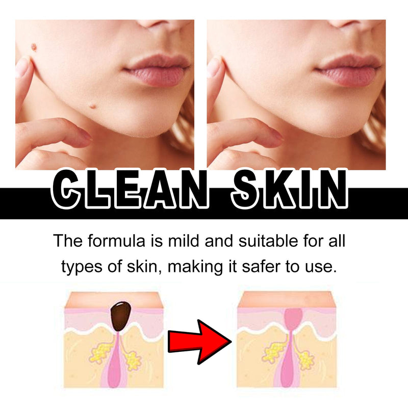 Wart Essence, Cleanses Skin, Restores And Smooths Body Skin Wart Treatment