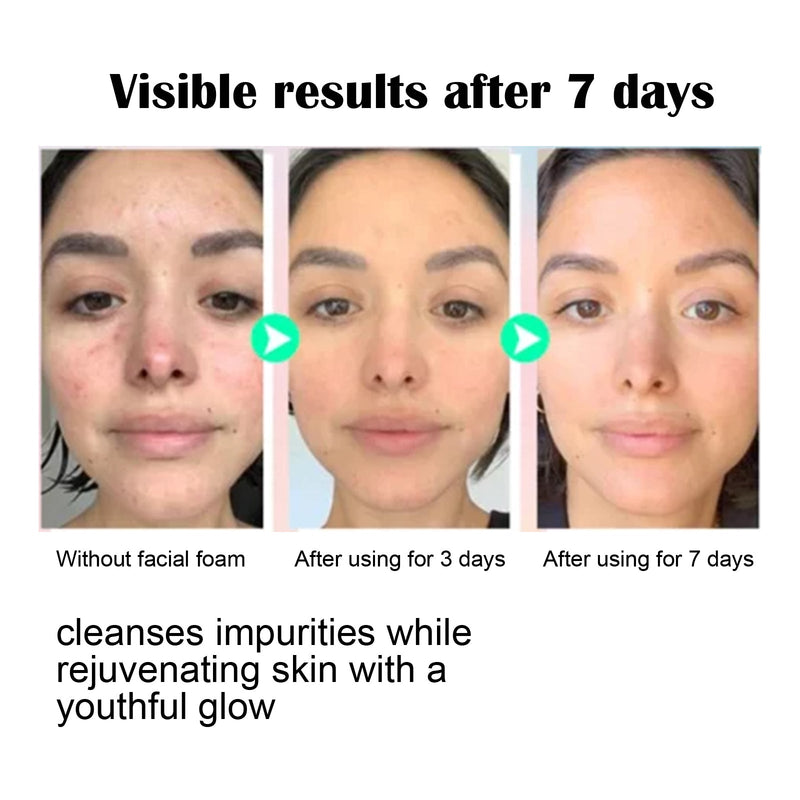 Facial Cleanser, Deep Clean Pores, Reduce Acne Marks, Moisturize, Soft And Firm Skin