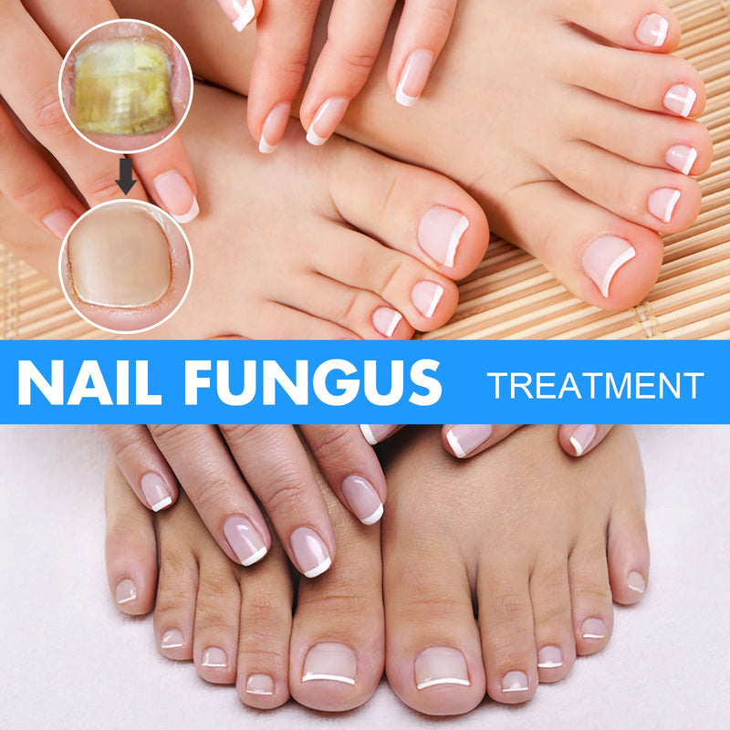 EELHOE Nail Repair Solution, Hand And Foot Gray Nail Care Repair Gray Nail Solution Thickening Soft Nails