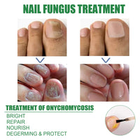 EELHOE Nail Repair Solution Tea Tree Oil Essence Gentle Nourishing Manicure Cleansing Soft Nail Care Solution