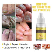 EELHOE Ginseng Nail Essential Oil Grey Nail Thickening Nail Repair Brightening Nail Removing Soft Nail Moisturizing Essence