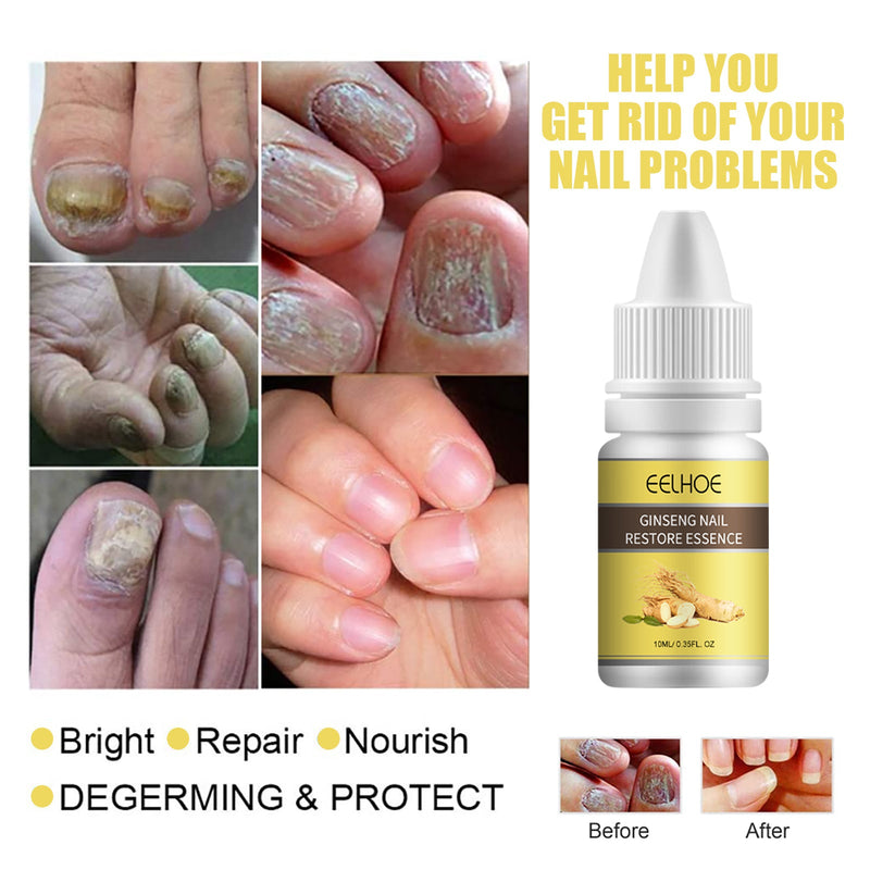 EELHOE Ginseng Nail Essential Oil Grey Nail Thickening Nail Repair Brightening Nail Removing Soft Nail Moisturizing Essence