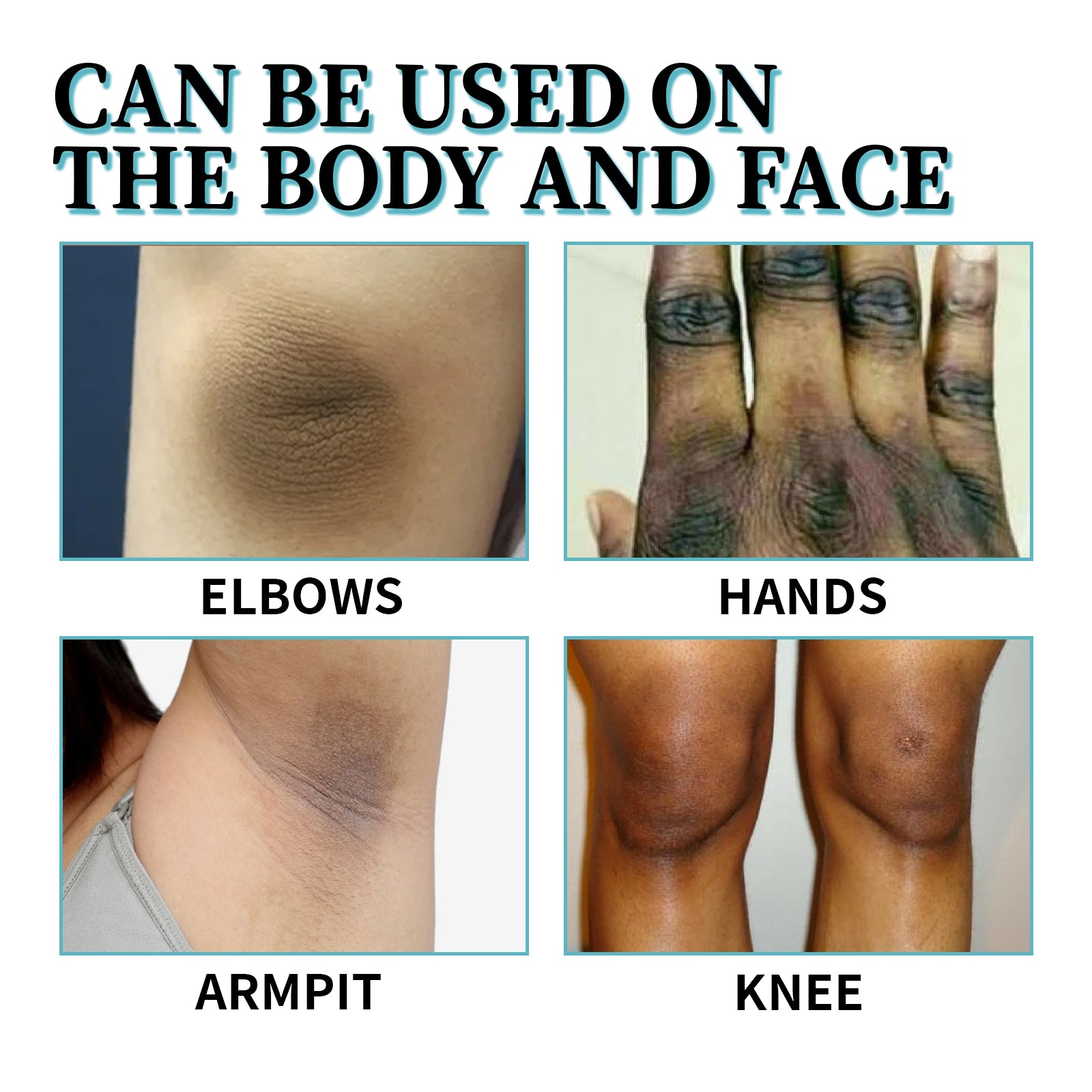 Acanthosis Nigricans Therapy Lotion, Armpit Joint Knee Fade Melanin Deep Nourishing Whitening Skin Tender Skin