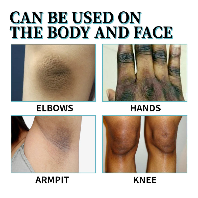 Acanthosis Nigricans Therapy Lotion, Armpit Joint Knee Fade Melanin Deep Nourishing Whitening Skin Tender Skin