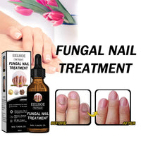 EELHOE Nail Repair Solution Thickening Brightening Nails Removing Gray Nails Dead Skin Repair Nourishing Nail Care Solution
