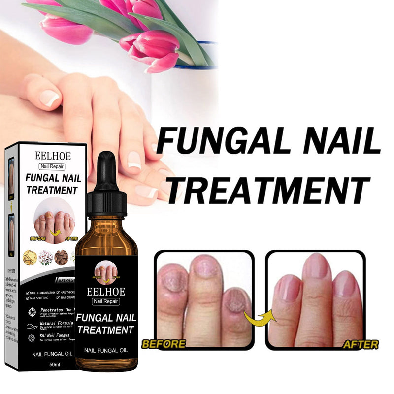 EELHOE Nail Repair Solution Thickening Brightening Nails Removing Gray Nails Dead Skin Repair Nourishing Nail Care Solution