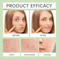 Anti-Acne Patch, Gentle Cleansing Helps Relieve Facial Blemishes Appearance Concealer Breathable Facial Care Patch