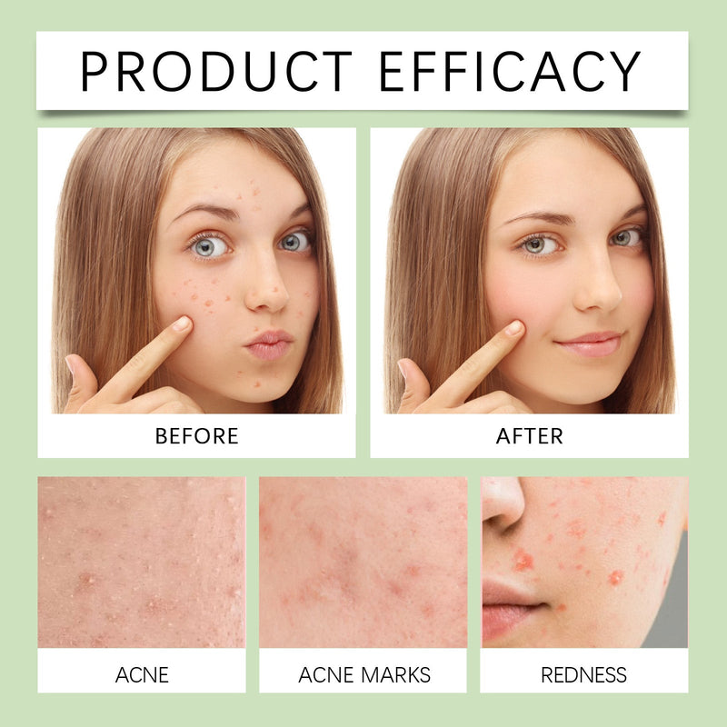 Anti-Acne Patch, Gentle Cleansing Helps Relieve Facial Blemishes Appearance Concealer Breathable Facial Care Patch