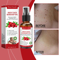 Rosehip Seed And Wart Essence Oil, Moisturizes And Restores Smooth Skin