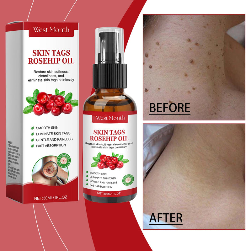 Rosehip Seed And Wart Essence Oil, Moisturizes And Restores Smooth Skin
