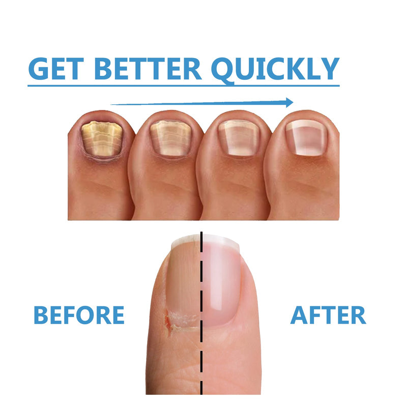 Nighttime Fungal Nail Treatment Patch, Repair Hand And Foot Inlay Rotten Nails Thickening Gray Nail Polish Care Patch