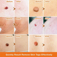 Flat and sharp warts, with a warm and moisturizing facial warts remover