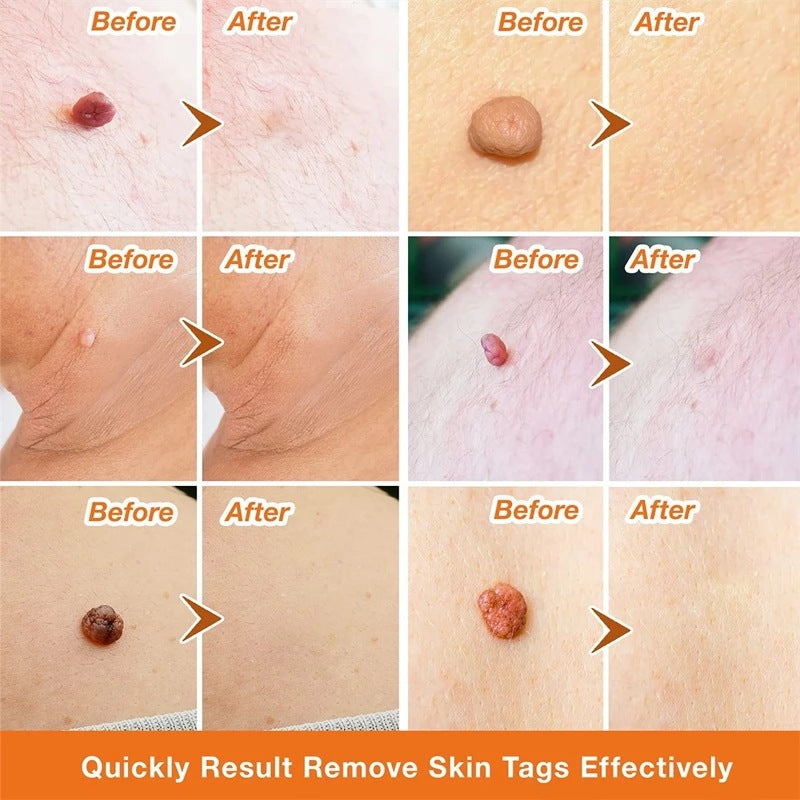 Flat and sharp warts, with a warm and moisturizing facial warts remover