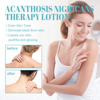 Acanthosis Nigricans Therapy Lotion, Armpit Joint Knee Fade Melanin Deep Nourishing Whitening Skin Tender Skin