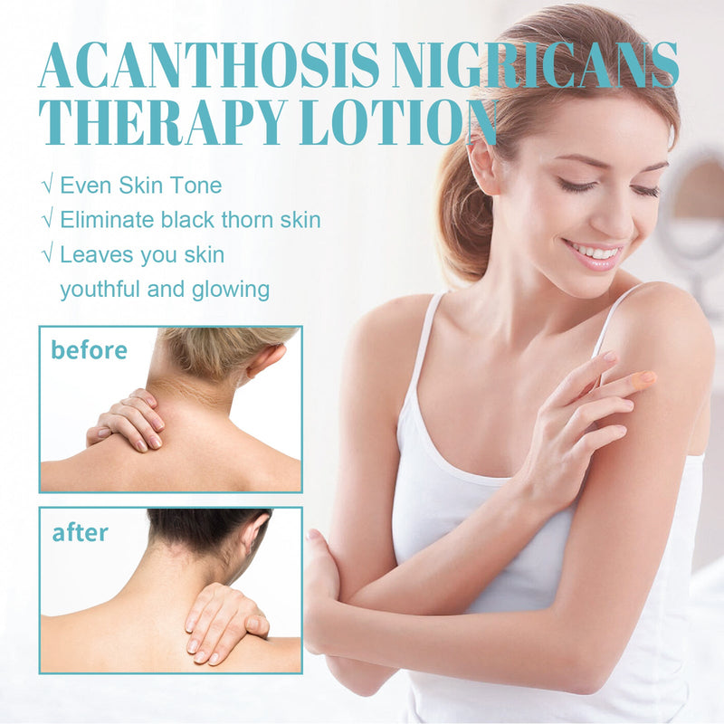 Acanthosis Nigricans Therapy Lotion, Armpit Joint Knee Fade Melanin Deep Nourishing Whitening Skin Tender Skin