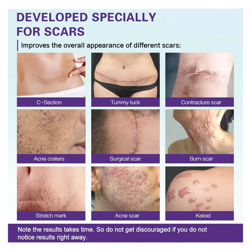 West&Month High-quality Silicone Scar Gel, Lighten Acne Mark Scar Repair Skin Smoothing Care Cream