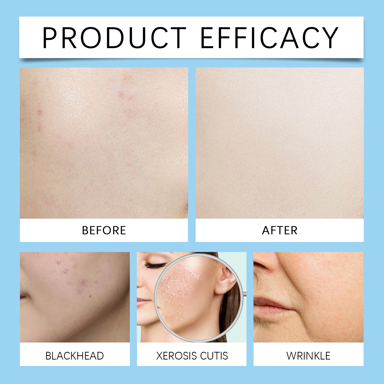 2% Salicylic Acid Balancing Repair Serum, Moisturizing And Improving Acne Closing Essence