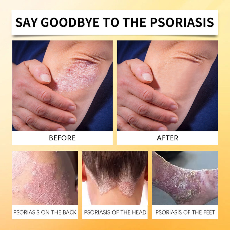 Bee Venom Psoriasis Care Spray, Psoriasis Spray Herbal Cooling Anti-Itch Skin Care Anti-Dandruff Light Redness Spray