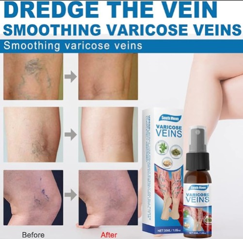 South Moon - Varicose Veins