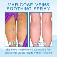 OUHOE Vein Treatment Spray, Relieve Leg Soreness And Swelling Repair Earthworm Leg Vein Treatment Spray