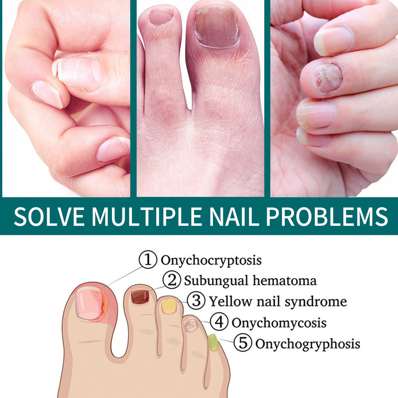 Toenail Repair Solution Smoothing Nail And Hand, Foot And Nail Cleansing And Nourishing Repair Solution
