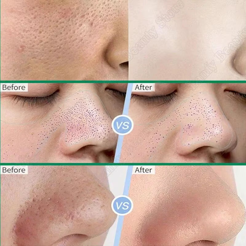 Salicylic Acid Pore Clearing Cream Shrink Pores Remove Blackheads Acne Brighten Moisturizing Smooth Skin Care Korean Products