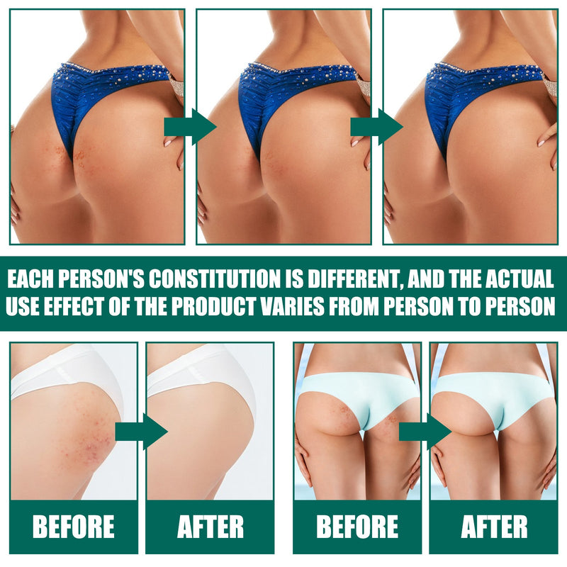 Butt Cream, Moisturizing Lighten Acne Mark Fresh Skin Moisturizing Mild Repair Acne Cream