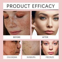 Freckle Whitening Brightening Serum, Brightening And Firming Skin Plant Extract