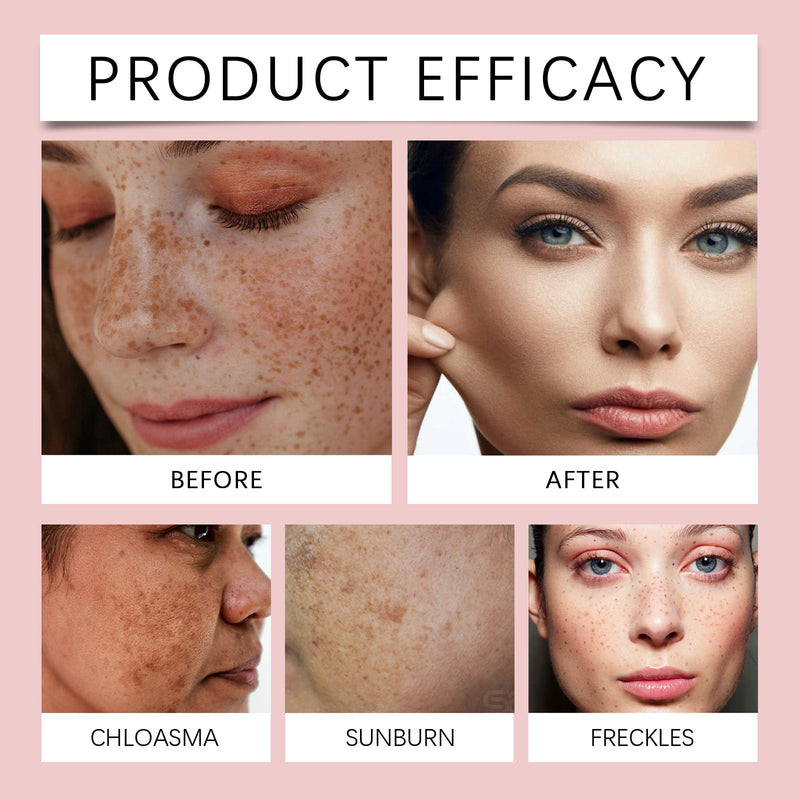 OUHOE Freckle Whitening Serum - Brightening Firming Plant Extract Care
