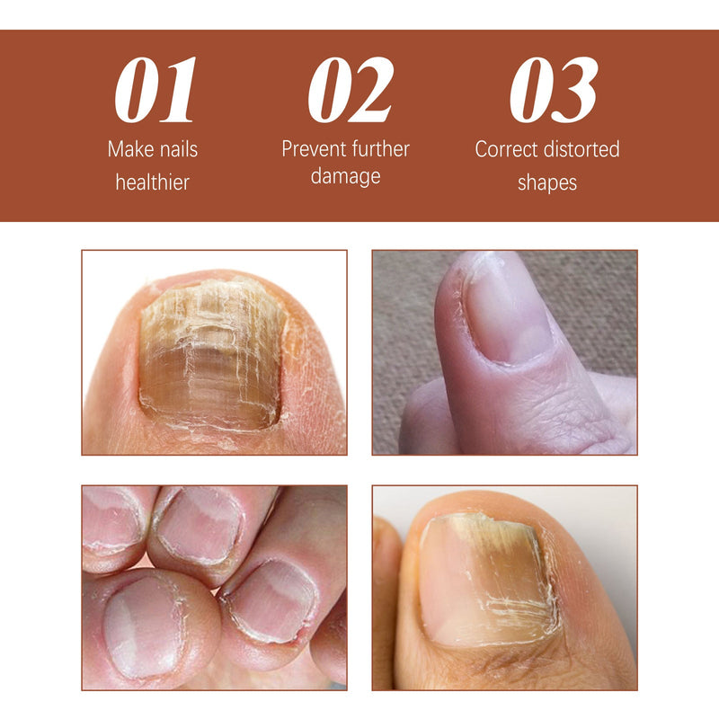 Nail Care Essence Hand And Foot Gray Nail Repair Soft Nail Thickening Moisturizing Nail Care Essence