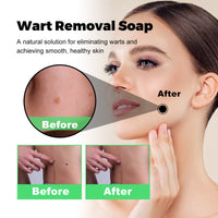 South Moon Skin Tag Removal Rubber Band, Remove Moles Remove Warts Face Neck Flesh Granule Body Cleansing Soap