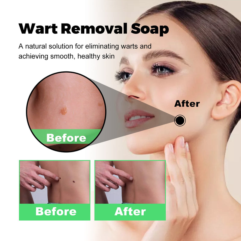 South Moon Skin Tag Removal Rubber Band, Remove Moles Remove Warts Face Neck Flesh Granule Body Cleansing Soap
