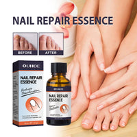 OUHOE Nail Repair Essence, Soft Nail Thickening Nails Smooth Ingrown Toenails Grey Nails Repair Essence