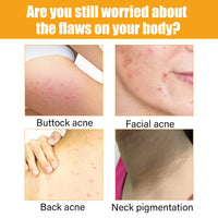 Jayusing Anti-Acne And Anti-Acne Serum, Reduce Acne And Acne Mark Moisturizing Skin Repair Serum