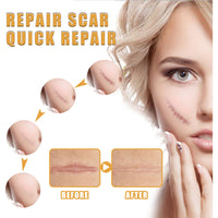 EELHOE Desalting Skin Scar Cream, Skin Burn Scalding Surgical Scar Wound Repair Cream