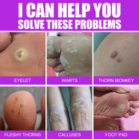 South Moon Remove Chicken Eye Lotion Extra Clear Remove Corns Skin Care Chicken Calluses Foot Pad Gram Warts