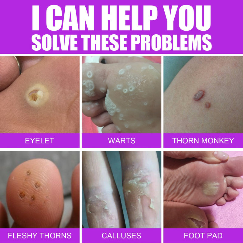 South Moon Remove Chicken Eye Lotion Extra Clear Remove Corns Skin Care Chicken Calluses Foot Pad Gram Warts